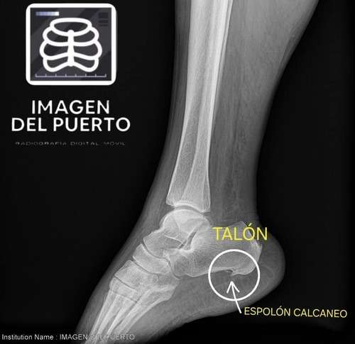 imagen de Radiografías de espolones_1