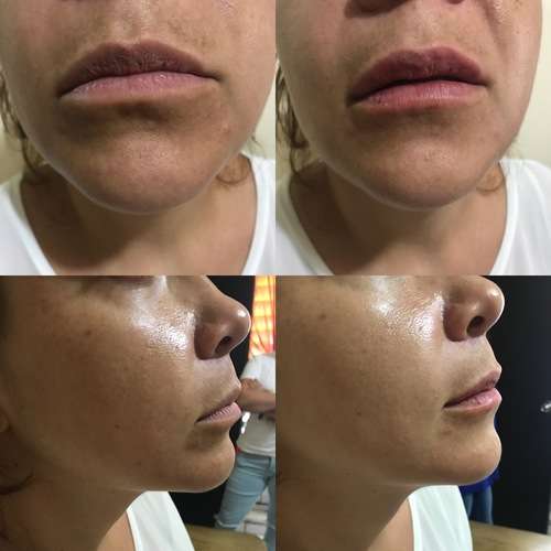 imagen de Aumento de labios con Acido Hialuronico_2