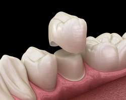 imagen de ¿Acabas de recibir una corona dental?_2